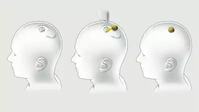 neuralink implant